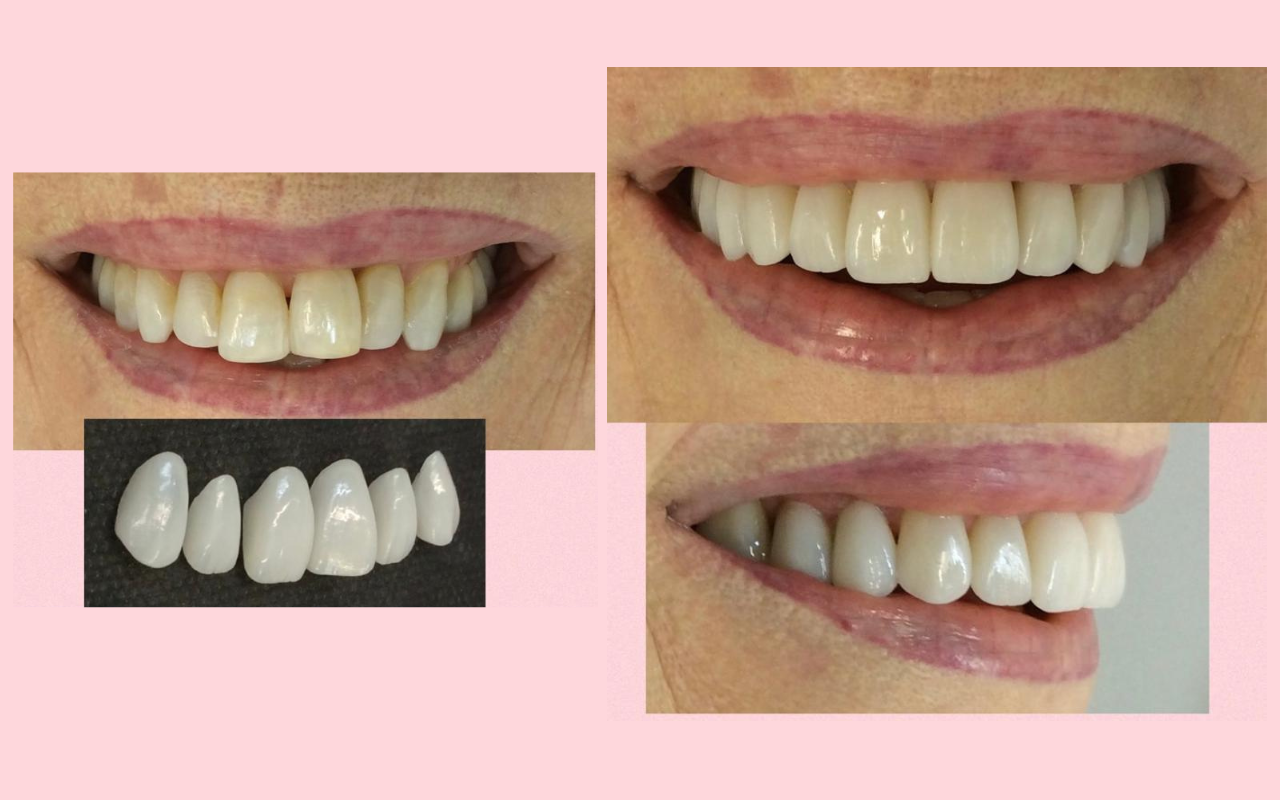 Detalhe das Lentes de Contato Dental aplicadas pela Dra. Fabiola Roggia